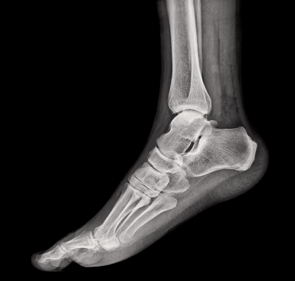 Lower Extremity X-Ray