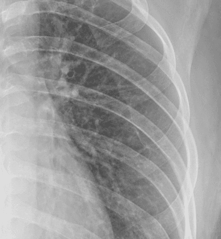 X-Ray with SBSC