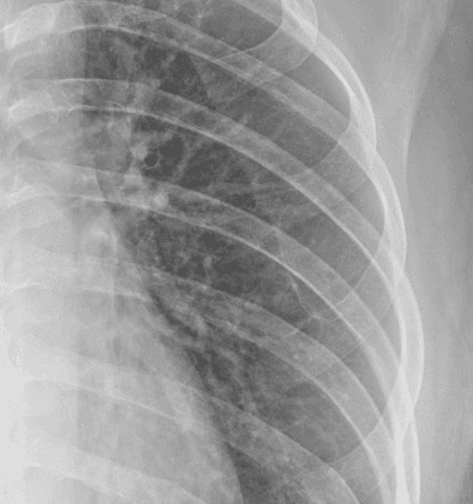 X-Ray without SBSC